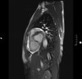 Acute perimyocarditis (Radiopaedia 48034-52833 Sagittal TRUFI CINE SHORT AXIS 60).JPG