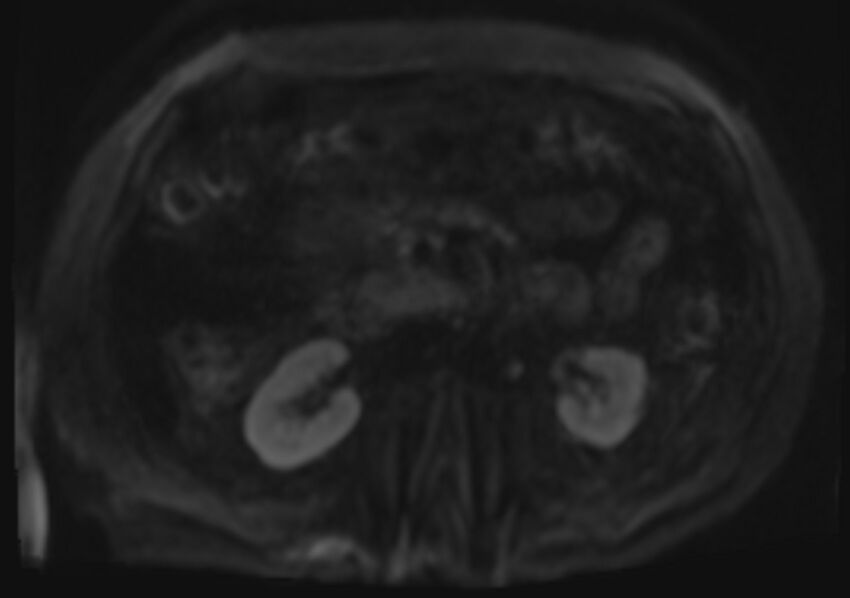 Acute portal vein thrombosis (Radiopaedia 73198-83925 Axial DWI 51).jpg