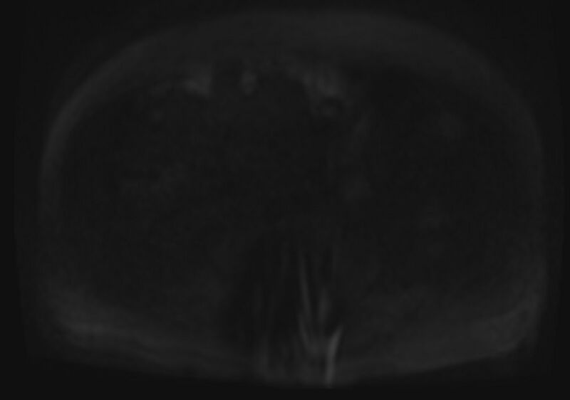 File:Acute portal vein thrombosis (Radiopaedia 73198-83925 Axial DWI 88).jpg