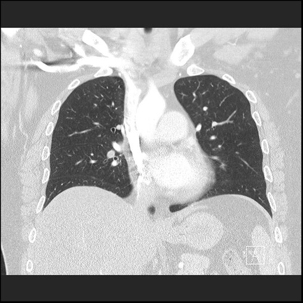 File:Acute pulmonary embolism with pulmonary infarct (Radiopaedia 73062-83768 Coronal lung window 35).jpg