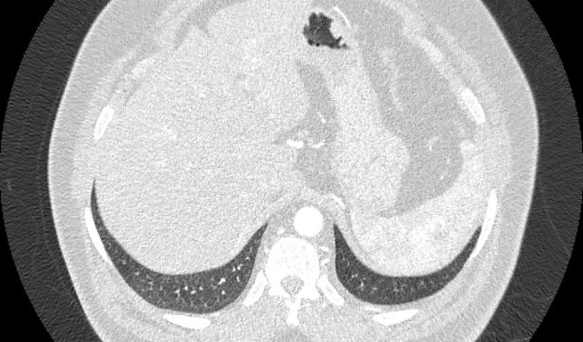 Acute pulmonary embolism with pulmonary infarcts (Radiopaedia 77688-89908 Axial lung window 127).jpg