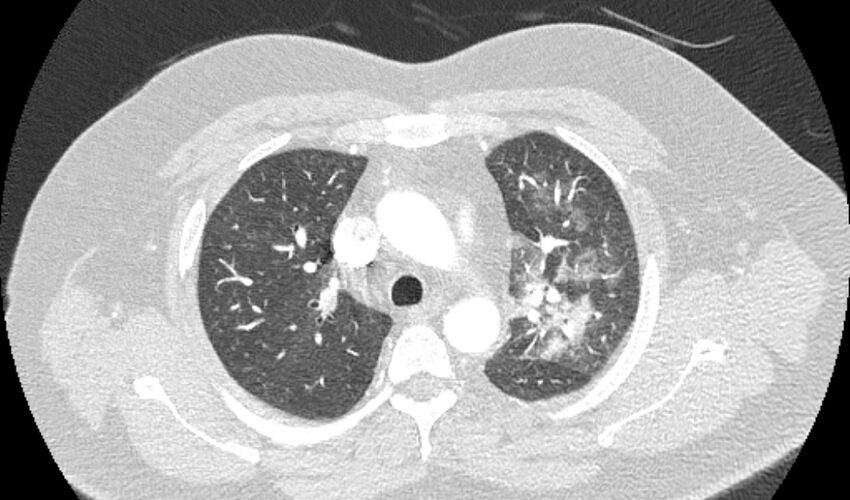 Acute pulmonary embolism with pulmonary infarcts (Radiopaedia 77688-89908 Axial lung window 30).jpg