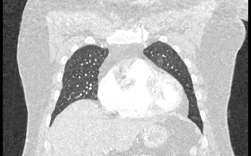 File:Acute pulmonary embolism with pulmonary infarcts (Radiopaedia 77688-89908 Coronal lung window 14).jpg