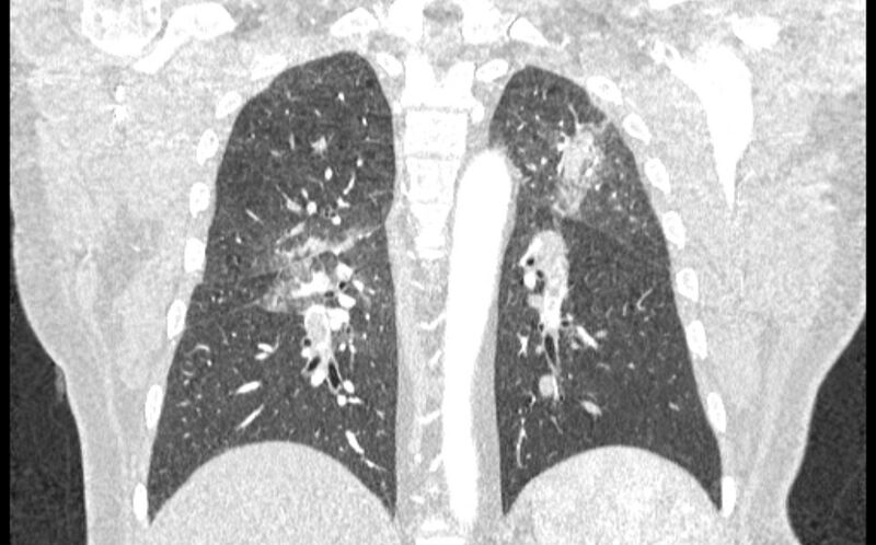 File:Acute pulmonary embolism with pulmonary infarcts (Radiopaedia 77688-89908 Coronal lung window 68).jpg