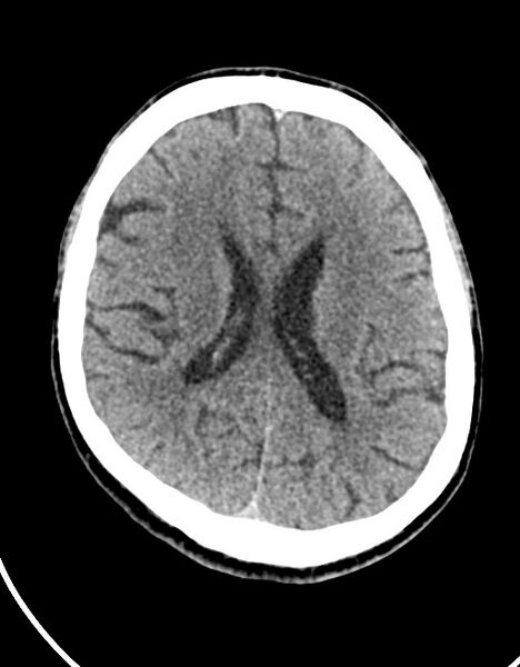 File:Acute superior cerebellar artery territory infarct (Radiopaedia 84104-99359 Axial non-contrast 30).jpg