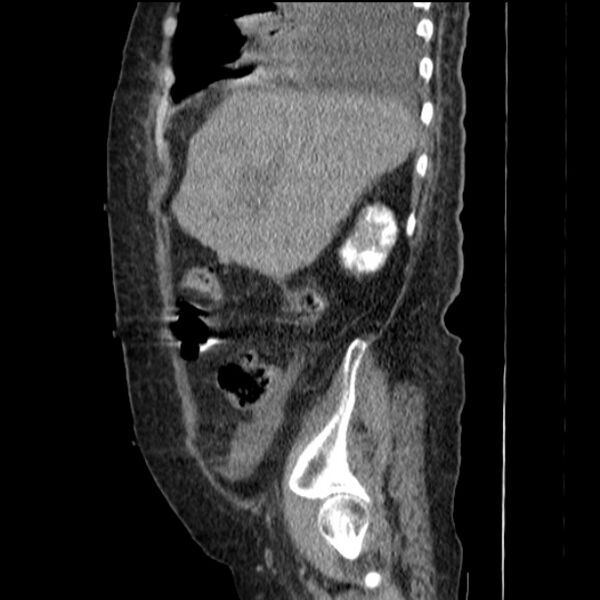 File:Acute tubular necrosis (Radiopaedia 28077-28334 Sagittal non-contrast 24).jpg