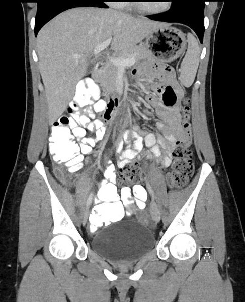 File:Acute uncomplicated appendicitis (Radiopaedia 61374-69304 Coronal C+ portal venous phase 43).jpg