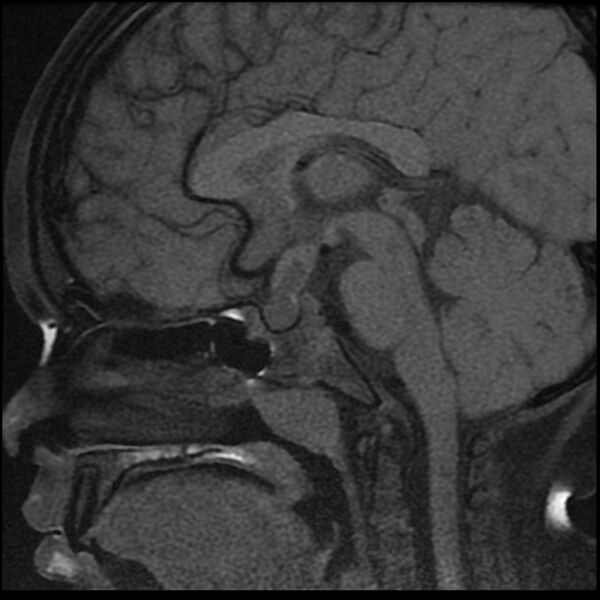 File:Adamantinomatous craniopharyngioma (Radiopaedia 77407-89529 Sagittal T1 fat sat 7).jpg