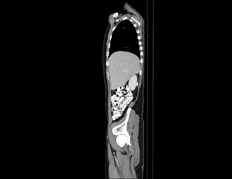 File:Addison disease (Radiopaedia 49318-54412 Sagittal C+ portal venous phase 55).jpg