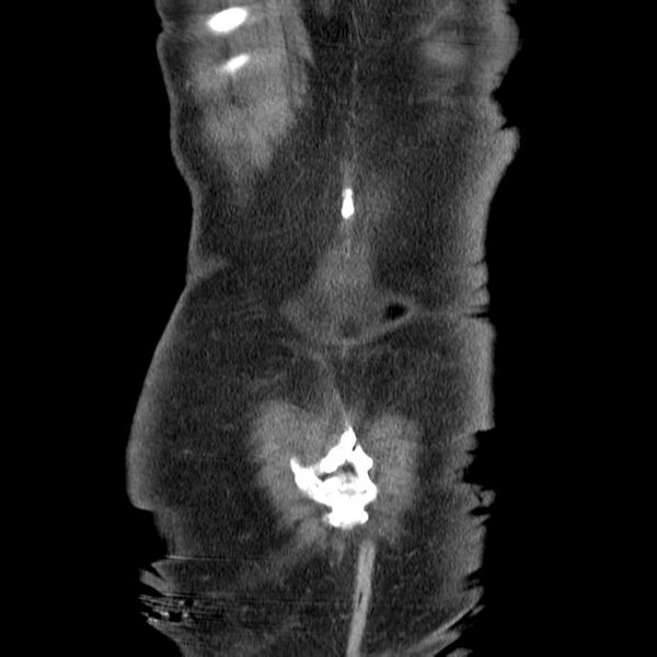 File:Adenocarcinoma of colon with entero-colic fistula (Radiopaedia 22832-22852 Coronal C+ portal venous phase 51).jpg