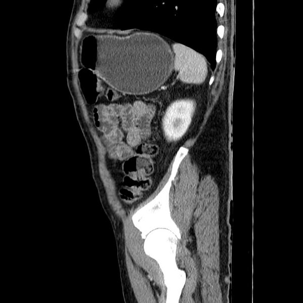 File:Adenocarcinoma of colon with entero-colic fistula (Radiopaedia 22832-22852 Sagittal C+ portal venous phase 53).jpg