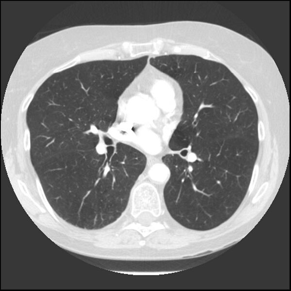 File:Adenocarcinoma of the lung (Radiopaedia 41015-43755 Axial lung window 64).jpg