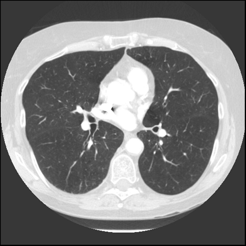 Adenocarcinoma of the lung (Radiopaedia 41015-43755 Axial lung window 64).jpg