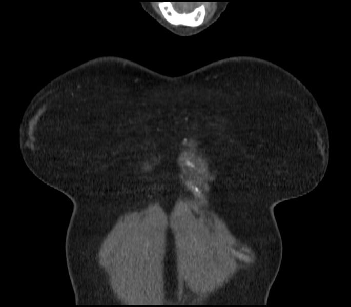 File:Adenocarcinoma of the lung (Radiopaedia 44205-47803 Coronal C+ portal venous phase 2).jpg