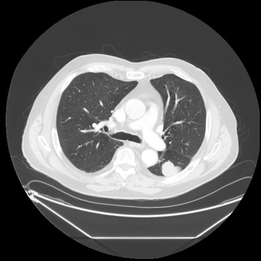 Adenocarcinoma of the lung (Radiopaedia 44876-48759 Axial lung window 33).jpg