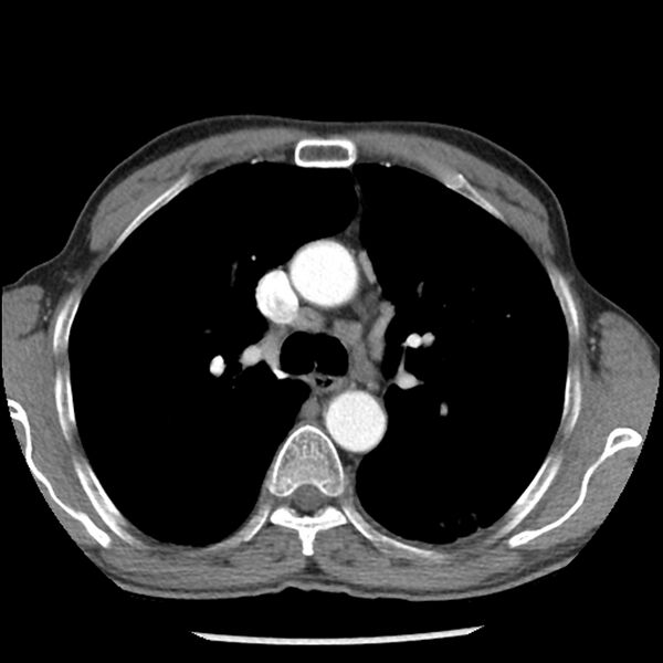 File:Adenocarcinoma of the lung - micropapillary predominant (Radiopaedia 42446-45563 Axial C+ portal venous phase 26).jpg