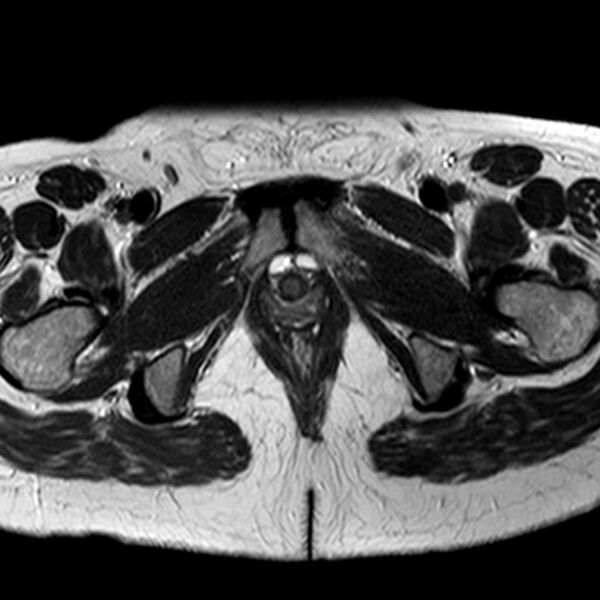 File:Adenomyoma of the uterus (Radiopaedia 9871-10439 Axial T2 3).jpg