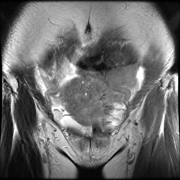 File:Adenomyosis on MRI (Radiopaedia 29328-29780 Coronal T2 15).jpg