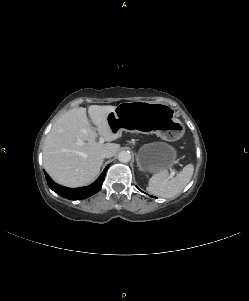 Adhesional small bowel obstruction (Radiopaedia 85402-101024 Axial C+ portal venous phase 65).jpg