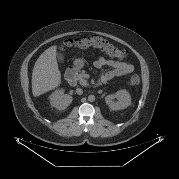 File:Adrenal myelolipoma (Radiopaedia 26278-26407 Axial non-contrast 25).jpg