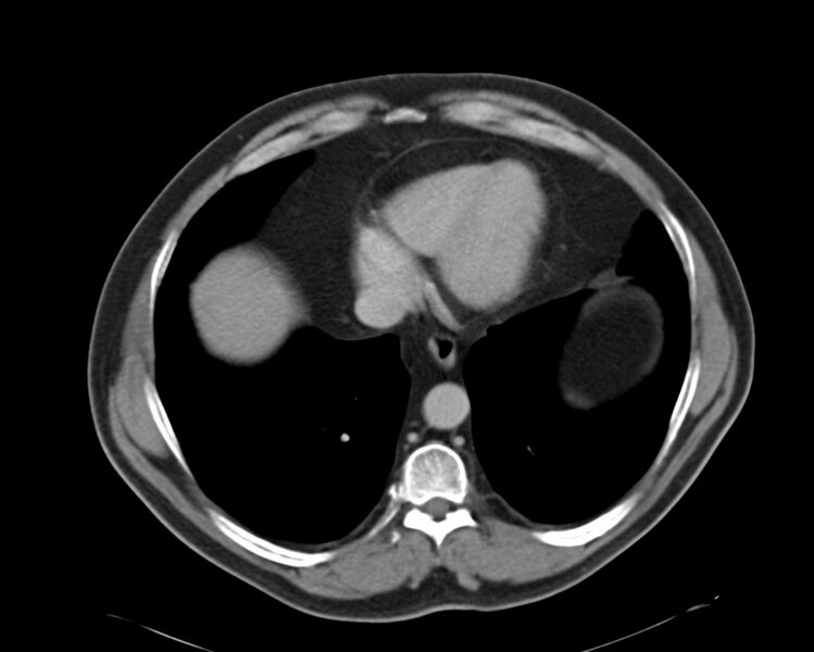 File:Adrenal myelolipoma (Radiopaedia 61778).jpg