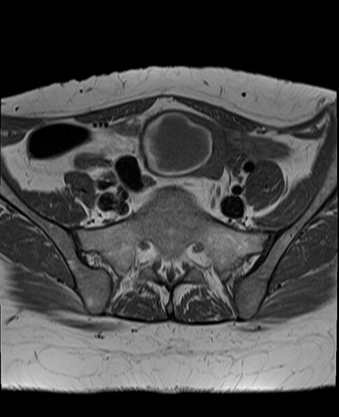 File:Adult granulosa cell tumor of the ovary (Radiopaedia 71581-81950 Axial T1 8).jpg