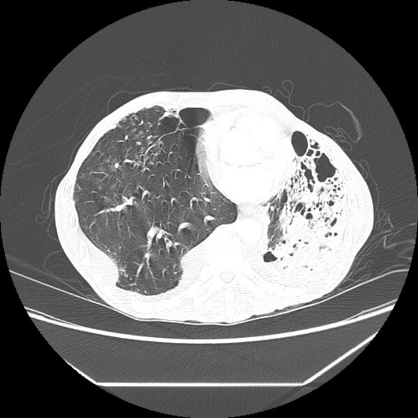 File:Advanced pulmonary tuberculosis (Radiopaedia 8599-9431 Axial lung window 36).jpg