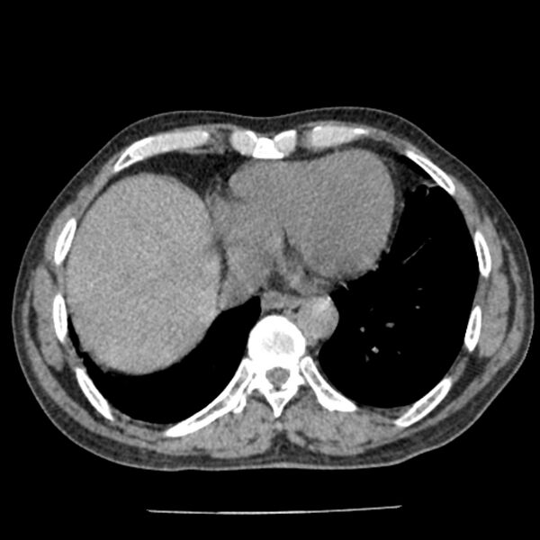 File:Airway foreign body in adult (Radiopaedia 85907-101779 Axial liver window 140).jpg