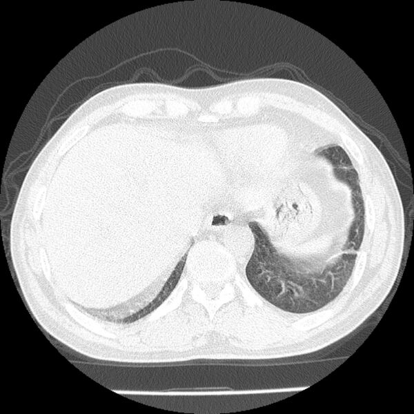 File:Airway foreign body in adult (Radiopaedia 85907-101779 Axial lung window 162).jpg