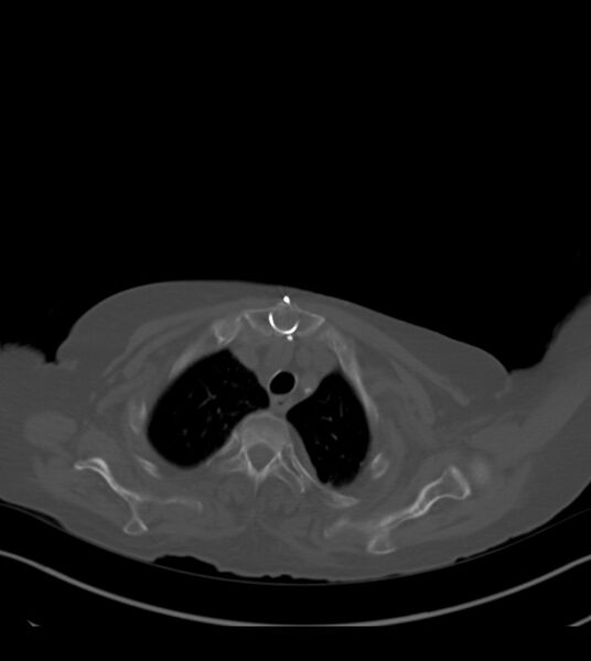 File:Amiodarone deposition in the liver (Radiopaedia 77587-89780 Axial bone window 14).jpg