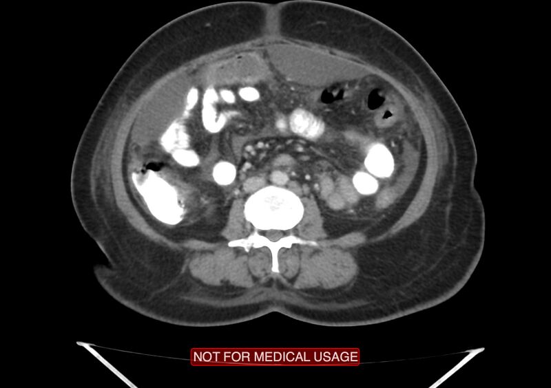 File:Amoebic enterocolitis with liver abscess (Radiopaedia 35100-36609 A 45).jpg