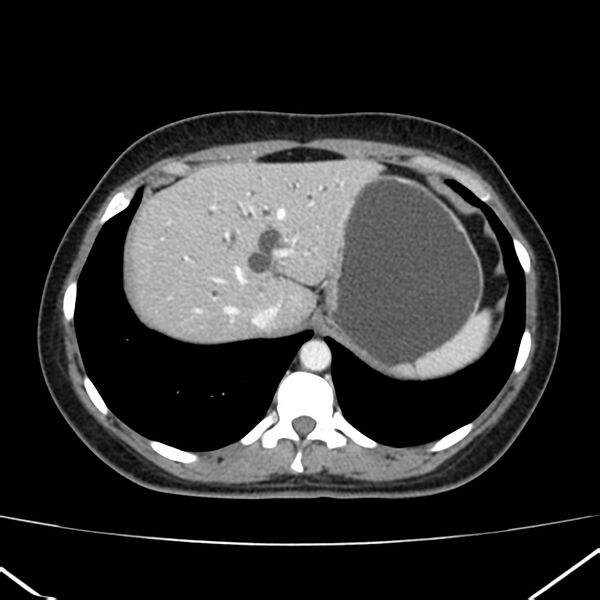 File:Ampullary tumor (Radiopaedia 22787-22816 C 11).jpg