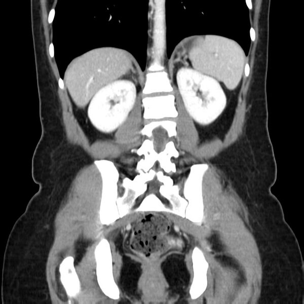 File:Ampullary tumor (Radiopaedia 22787-22816 E 38).jpg