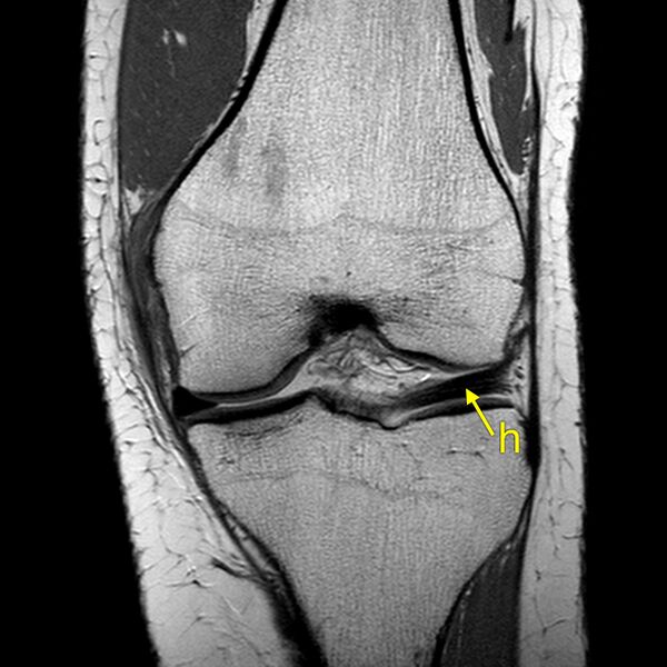File:Anatomy Quiz (MRI knee) (Radiopaedia 43478-46874 A 13).jpeg