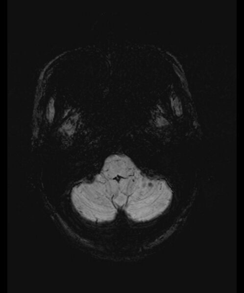 File:Angiomatous meningioma (Radiopaedia 79459-92579 E 6).jpg