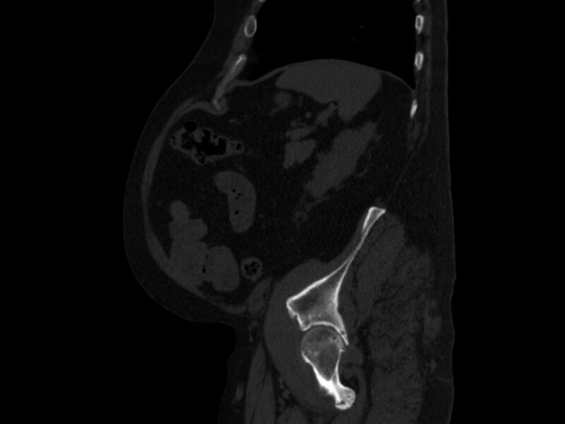 File:Ankylosing spondylitis (Radiopaedia 44609-48357 Sagittal bone window 90).jpg