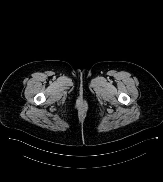 File:Anterior abdominal wall CSF pseudocyst (CSFoma) (Radiopaedia 79453-92571 A 102).jpg