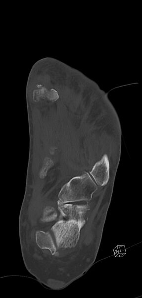 File:Anterior calcaneal process fracture (Radiopaedia 63353-71943 Coronal bone window 30).jpg