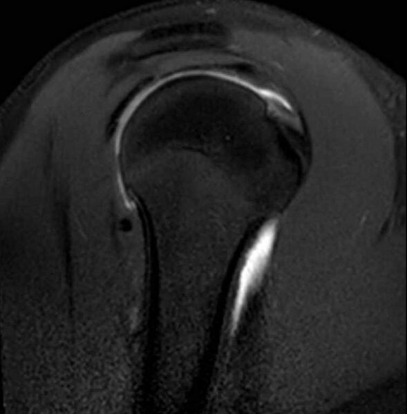 File:Anterior labral tear- extensive (Radiopaedia 73682-84476 Sagittal T2 fat sat 10).jpg