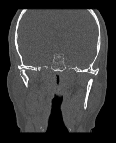 File:Antrochoanal polyp (Radiopaedia 79011-92169 Coronal bone window 2).jpg