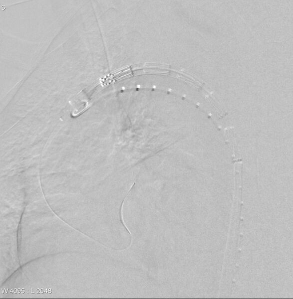 File:Aortic arch false aneurysm (Radiopaedia 14667-14589 Deployment of graft. 1).jpg