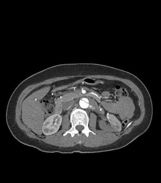 File:Aortic dissection with renal ischemia (Radiopaedia 76573-88338 A 70).jpg
