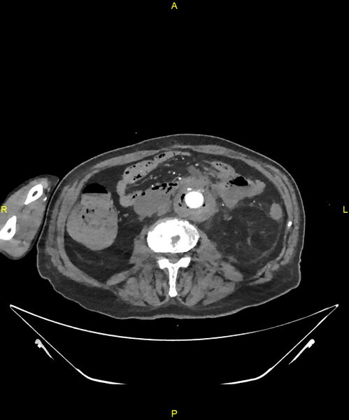 File:Aortoenteric fistula (Radiopaedia 84308-99603 B 191).jpg