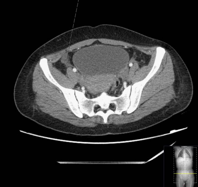 File:Appendicitis (CT angiogram) (Radiopaedia 154713-127660 Axial 10).jpg