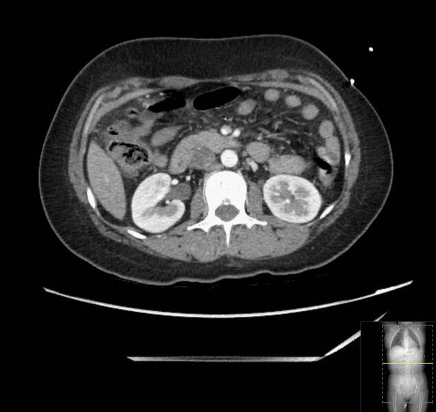 File:Appendicitis (CT angiogram) (Radiopaedia 154713-127660 Axial 109).jpg
