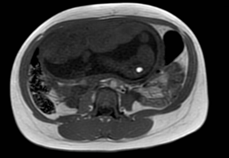 File:Appendicitis in gravida (MRI) (Radiopaedia 89433-106395 Axial T1 in-phase 34).jpg