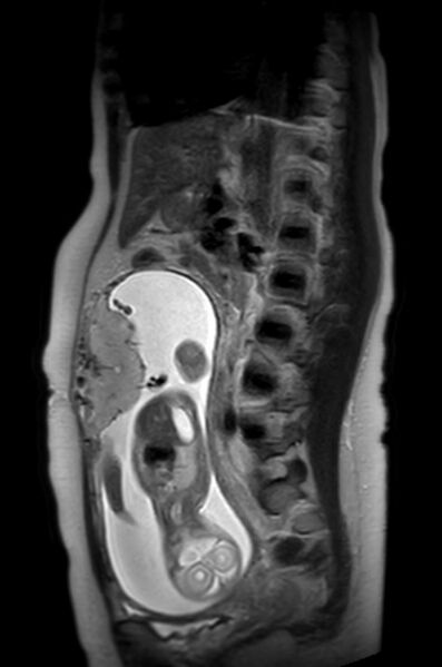 File:Appendicitis in gravida (MRI) (Radiopaedia 89433-106395 Sagittal T2 29).jpg