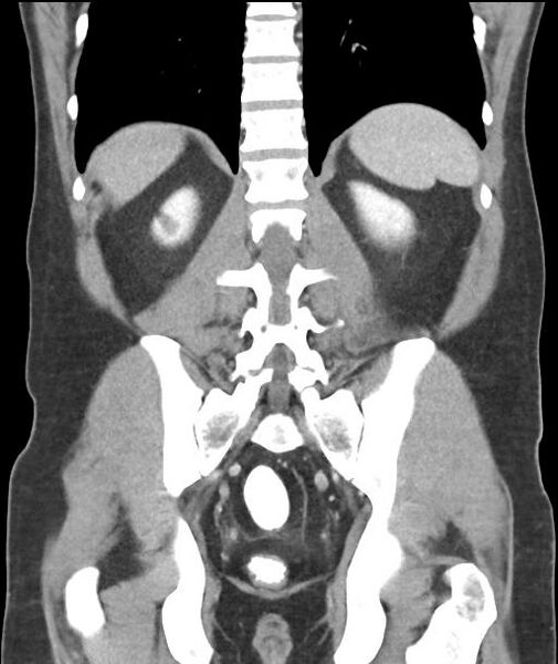File:Appendicitis with cecal bar sign (Radiopaedia 31878-32830 A 45).jpg