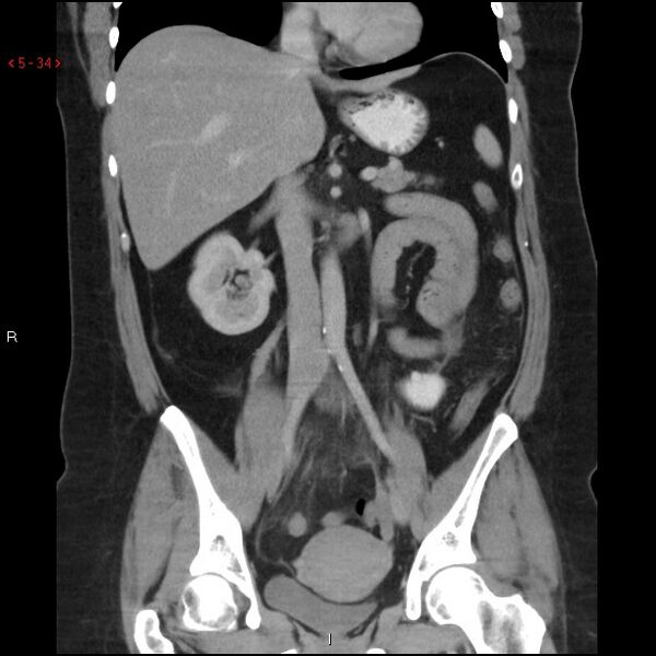 File:Appendicitis with microperforation- promontoric type (Radiopaedia 27268-27442 B 21).jpg