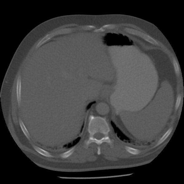 File:Appendicitis with perforation (Radiopaedia 35790-37342 Axial bone window 8).jpg